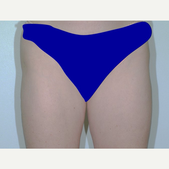 Liposuction after 3346069