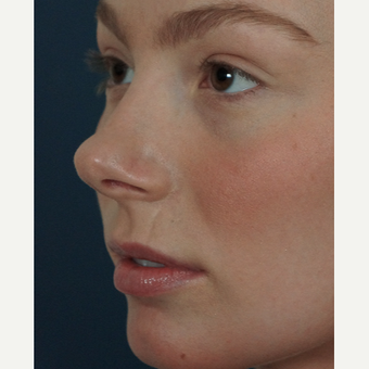 18-24 year old woman treated with Lip Augmentation before 3244992