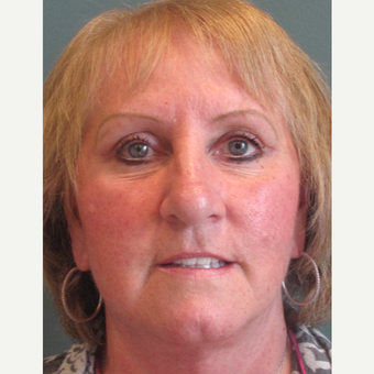 55-64 year old woman treated with Eyelid Surgery after 3713470