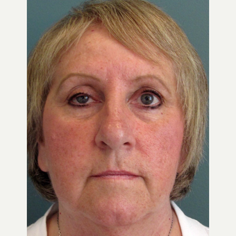 55-64 year old woman treated with Eyelid Surgery before 3713470