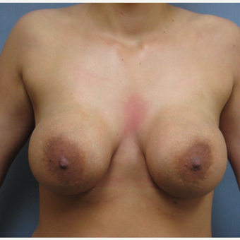 25-34 year old woman treated with Breast Implant Removal before 3300893