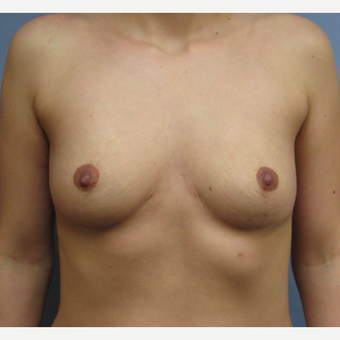 25-34 year old woman treated with Breast Implant Removal after 3300893