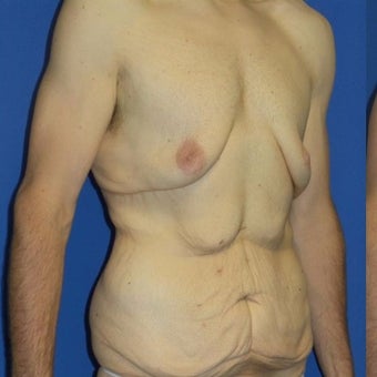 27 year old man treated with Body Lift before 2480269