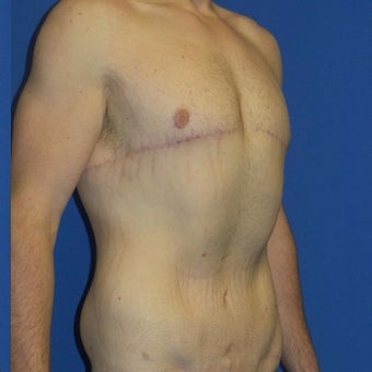 27 year old man treated with Body Lift after 2480269