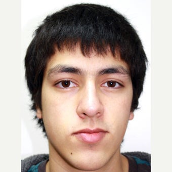 18-24 year old man treated with Orthognathic Surgery 1667480