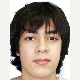 18-24 year old man treated with Orthognathic Surgery 1667480