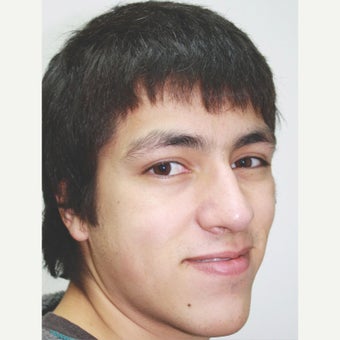 18-24 year old man treated with Orthognathic Surgery before 1667480