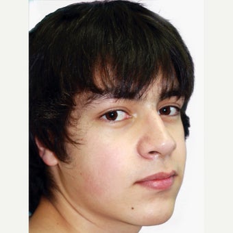 18-24 year old man treated with Orthognathic Surgery after 1667480