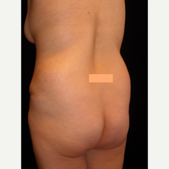 32 year old lady had fat transfer to the buttocks. before 3038491