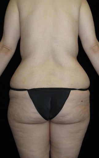 26 year old woman treated with Body Lift 3251734