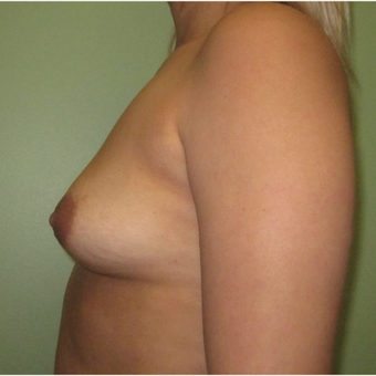 25-34 year old woman treated with Breast Augmentation before 3423962