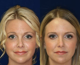 Non-surgical Rhinoplasty before 1224780