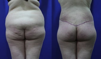 32 Year Old Treated for Abdominal Apron & Sagging Buttocks before 1109107