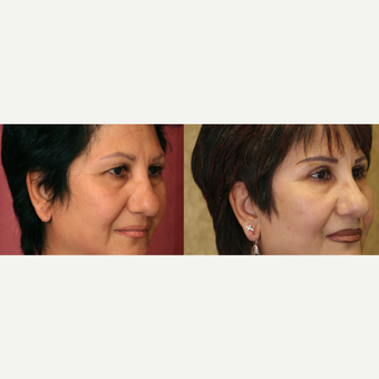 Eyelid surgery before and after pictures after 3424062