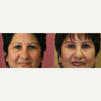Eyelid surgery before and after pictures before 3424062