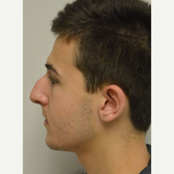 17 year old man treated with Nose Surgery before 3123038