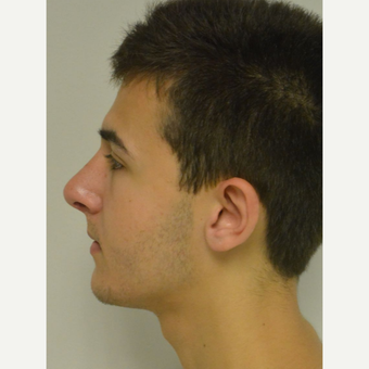 17 year old man treated with Nose Surgery after 3123038