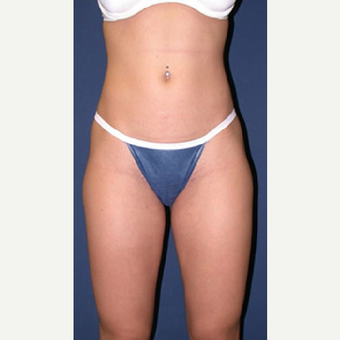 45-54 year old woman treated with SAFELipo after 3126323