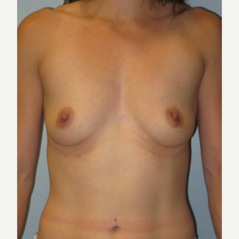 25-34 year old woman treated with Breast Augmentation before 3570442