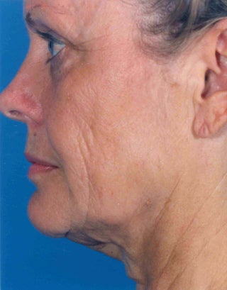 Facelift 1047980