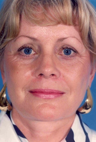 Facelift after 1047980