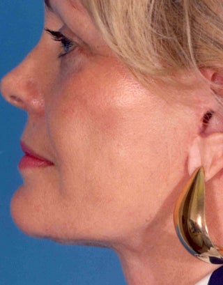 Facelift 1047980