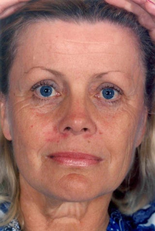 Facelift before 1047980