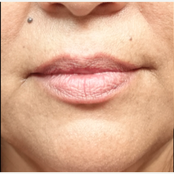 45-54 year old woman treated with Restylane Silk before 3280248