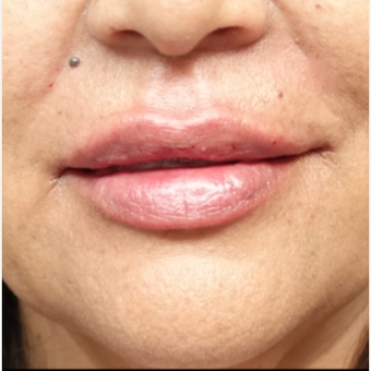 45-54 year old woman treated with Restylane Silk after 3280248