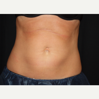 35-44 year old woman treated with CoolSculpting after 3417820
