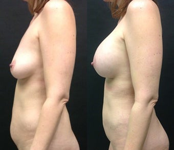 Mini Tummy Tuck before 1306432