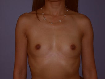 Breast Augmentation on 37-year-old Woman before 1144150