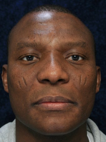 40 Year Old Male With Facial Scars before 1132320