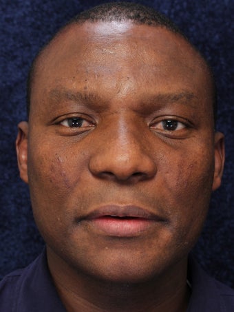 40 Year Old Male With Facial Scars after 1132320