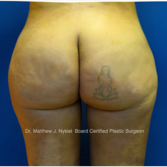 35-44 year old woman treated with Brazilian Butt Lift Revision after 2967748