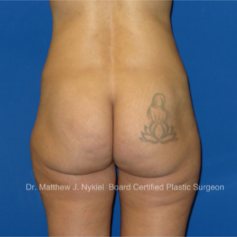 35-44 year old woman treated with Brazilian Butt Lift Revision before 2967748
