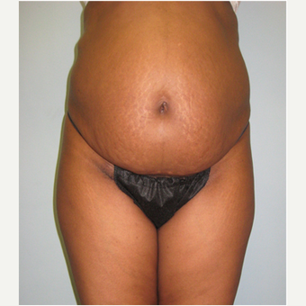 45 year old woman treated with Tummy Tuck before 3680183