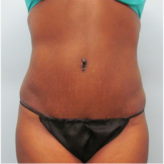 45 year old woman treated with Tummy Tuck after 3680183