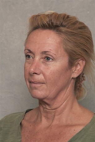 Neck Lift before 1392507