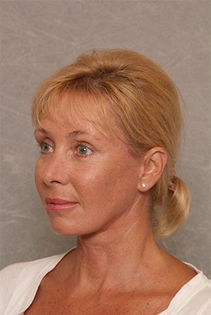 Neck Lift after 1392507