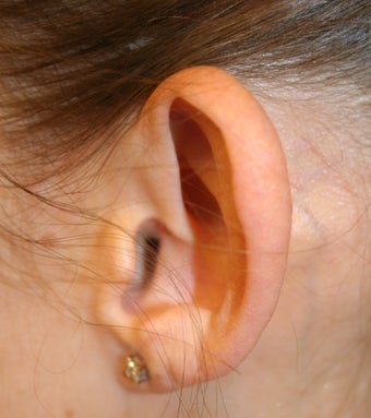 Otoplasty before 1310059