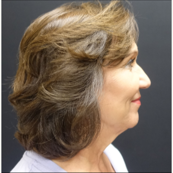 65-74 year old woman treated with Facelift before 3244842