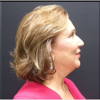 65-74 year old woman treated with Facelift after 3244842