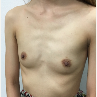 Breast Augmentation in a small volume thin lady before 3012965