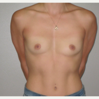 25-34 year old woman treated with Breast Implants before 3666677