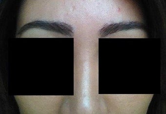 Before and after excision of eyebrow scars with subsequent eyebrow transplant of 700 grafts after 1141894