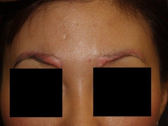 Before and after excision of eyebrow scars with subsequent eyebrow transplant of 700 grafts before 1141894