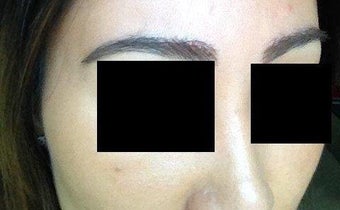 Before and after excision of eyebrow scars with subsequent eyebrow transplant of 700 grafts 1141894
