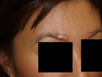 Before and after excision of eyebrow scars with subsequent eyebrow transplant of 700 grafts 1141894