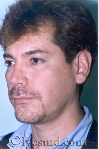 Rhinoplasty, Face and Neck Liposuction, Chin Correction after 226307